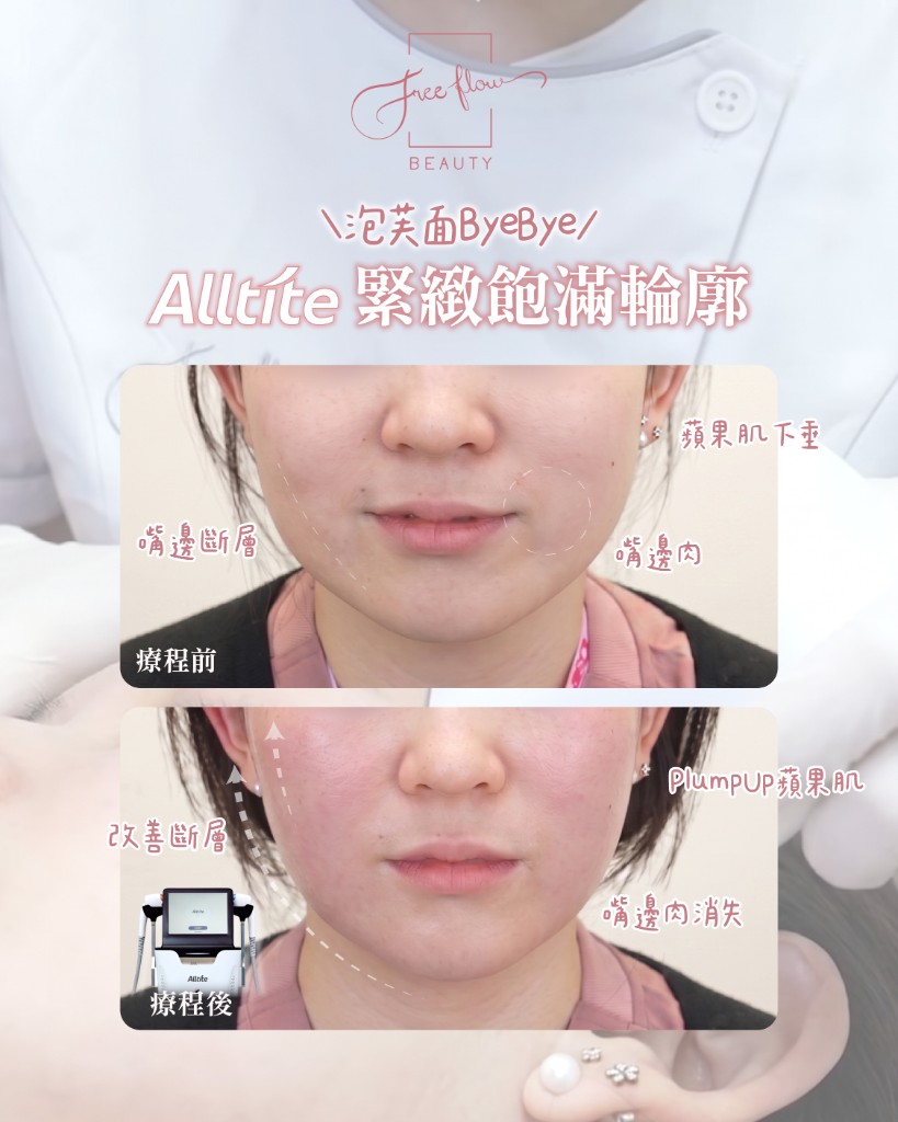 Alltite 療程前後輪廓改善參考