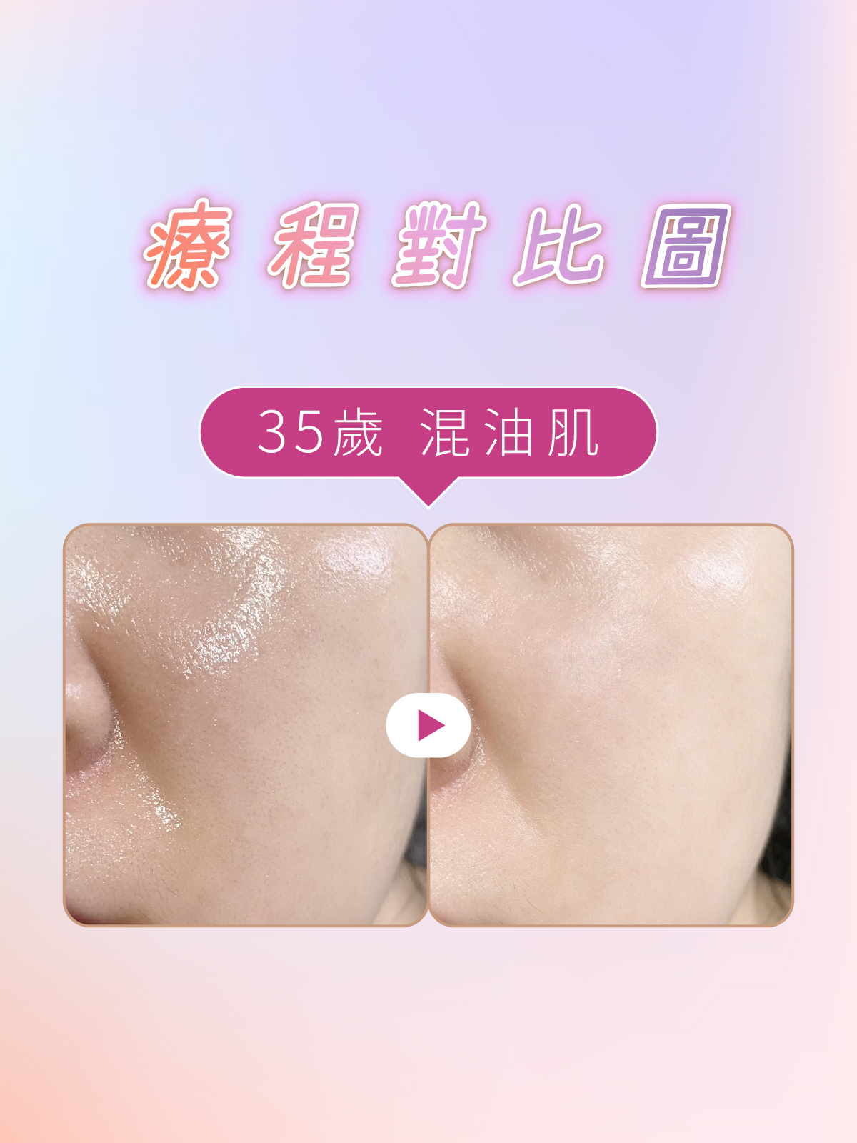 iff 啞光肌養成 對比參考 3